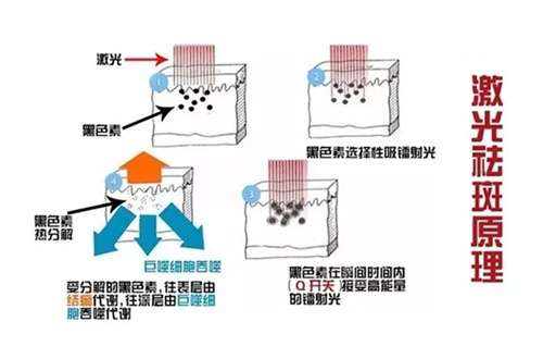 激光祛斑几天可以碰水?需要做几次?一键解析问题